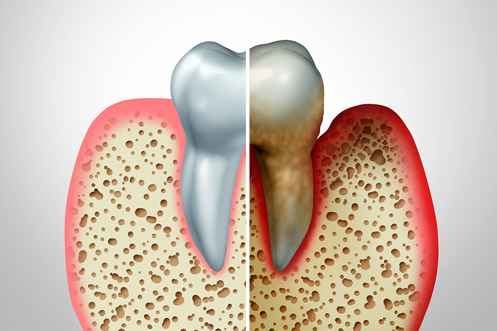 Parodontite o piorrea studio medico dentistico Santapollonia