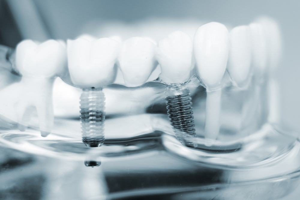 Radiografia Impianto-Studio Medico Dentistico Sant'Apollonia